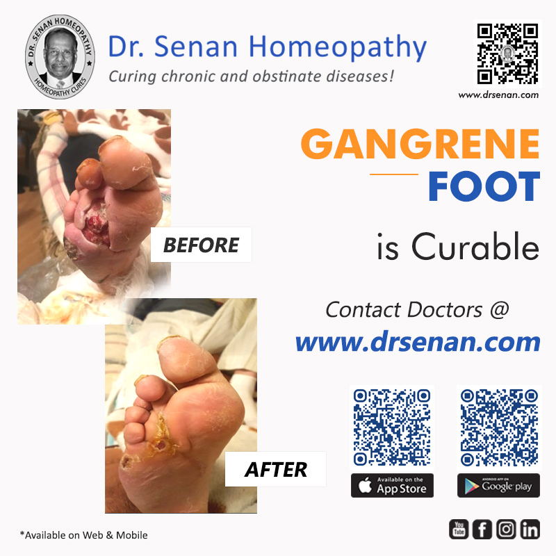 Gangrene